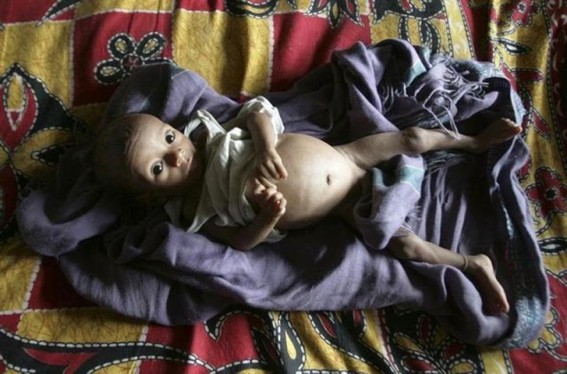 Five-month-old Rotiya Ashur, who suffers from tuberculosis, rests inside the tuberculosis ward of a hospital on the outskirts of Siliguri April 7, 2007. REUTERS/Rupak De/Files