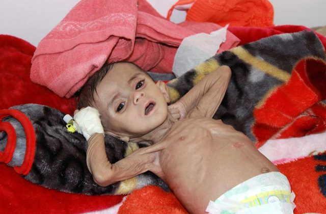 Desnutrición, malnutrición en Yemen