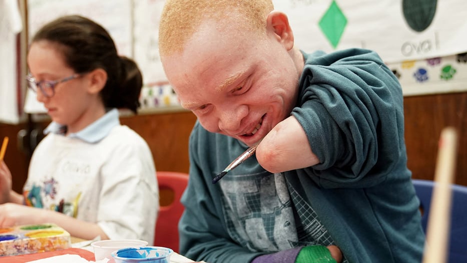 La COVID-19 agrava la situación de las personas con albinismo en África Austral
