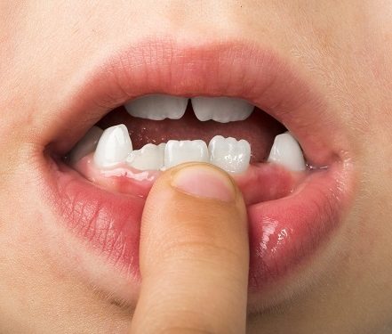 Estrecho Microbio plan Por qué los dientes humanos ahora son más débiles que antes?