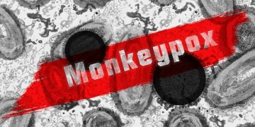 La viruela del mono sigue encendiendo las alarmas. Por ahora la enfermedad es "leve" y no afecta de forma importante a quienes la padecen. Foto Pixabay